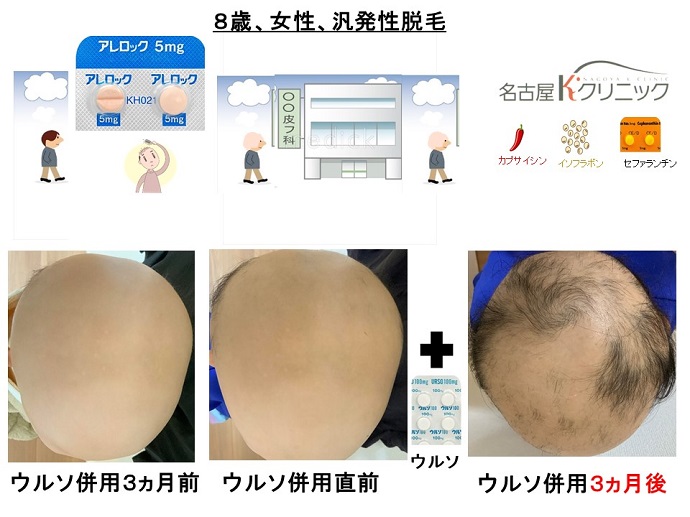 円形脱毛症　病院